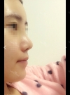 Bye Bye an ugly nose — Korea cost, reviews & before-after | MISOODA