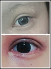 1 Week new eyes and nose with no bruise >< — Korea cost, reviews & before-after | MISOODA