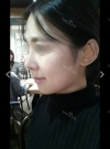 Nose Review! From a low bridge big nose to a desired nose!~~ — Korea cost, reviews & before-after | MISOODA