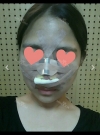 Nose Review! From a low bridge big nose to a desired nose!~~ — Korea cost, reviews & before-after | MISOODA