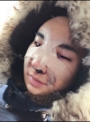 Expensive nose TT — Korea cost, reviews & before-after | MISOODA