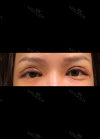 Review the 365000 costing eyes revision — Korea cost, reviews & before-after | MISOODA