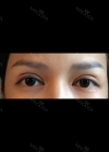 Review the 365000 costing eyes revision — Korea cost, reviews & before-after | MISOODA