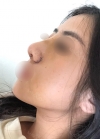 Rhinoplasty with Misooda and JW Plastic Surgery — Korea cost, reviews & before-after | MISOODA