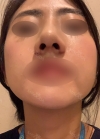 Rhinoplasty with Misooda and JW Plastic Surgery — Korea cost, reviews & before-after | MISOODA