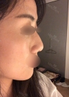 Rhinoplasty with Misooda and JW Plastic Surgery — Korea cost, reviews & before-after | MISOODA