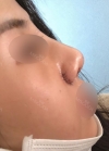 Rhinoplasty with Misooda and JW Plastic Surgery — Korea cost, reviews & before-after | MISOODA