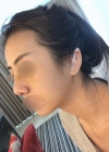 Rhinoplasty with Misooda and JW Plastic Surgery — Korea cost, reviews & before-after | MISOODA