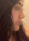 Rhinoplasty with Misooda and JW Plastic Surgery — Korea cost, reviews & before-after | MISOODA