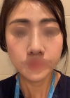 Rhinoplasty with Misooda and JW Plastic Surgery — Korea cost, reviews & before-after | MISOODA