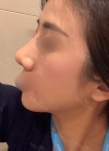 Rhinoplasty with Misooda and JW Plastic Surgery — Korea cost, reviews & before-after | MISOODA