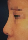 Beautiful Nose revision with Topface via Misooda.com — Korea cost, reviews & before-after | MISOODA