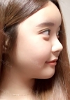 Yepoong-ee’s Plastic Surgery Real Review — Korea cost, reviews & before-after | MISOODA