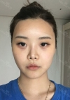 Yepoong-ee’s Plastic Surgery Real Review — Korea cost, reviews & before-after | MISOODA