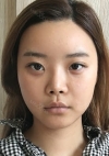 Yepoong-ee’s Plastic Surgery Real Review — Korea cost, reviews & before-after | MISOODA