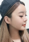 Yepoong-ee’s Plastic Surgery Real Review — Korea cost, reviews & before-after | MISOODA