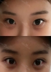 Yepoong-ee’s Plastic Surgery Real Review — Korea cost, reviews & before-after | MISOODA