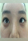 Yepoong-ee’s Plastic Surgery Real Review — Korea cost, reviews & before-after | MISOODA
