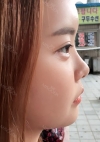 Yepoong-ee’s Plastic Surgery Real Review — Korea cost, reviews & before-after | MISOODA