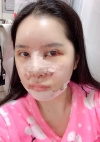Double Eyelid Surgery, Nose Revision, Facial bone-Square jaw — Korea cost, reviews & before-after | MISOODA