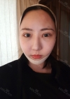 Double Eyelid + Rhinoplasty + Fat Graft + Facial Bone — Korea cost, reviews & before-after | MISOODA