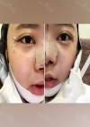 Yepoong-ee’s Plastic Surgery Real Review — Korea cost, reviews & before-after | MISOODA