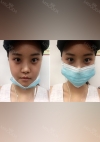 Yepoong-ee’s Plastic Surgery Real Review — Korea cost, reviews & before-after | MISOODA