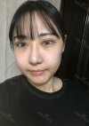 Double Eyelid + Rhinoplasty + Fat Graft + Facial Bone — Korea cost, reviews & before-after | MISOODA