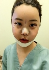 Yepoong-ee’s Plastic Surgery Real Review — Korea cost, reviews & before-after | MISOODA