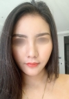 Expensive nose TT — Korea cost, reviews & before-after | MISOODA