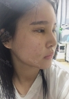 Nose, Eye, Fat inject — Korea cost, reviews & before-after | MISOODA