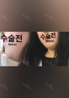 facial liposuction — Korea cost, reviews & before-after | MISOODA