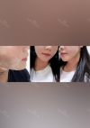 Facial liposuction, Thread Lifting — Korea cost, reviews & before-after | MISOODA