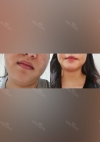 Facial liposuction, Thread Lifting — Korea cost, reviews & before-after | MISOODA