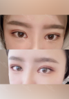 Double eyelids revision : 2 weeks at REN! — Korea cost, reviews & before-after | MISOODA