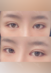 Double eyelids revision : 2 weeks at REN! — Korea cost, reviews & before-after | MISOODA
