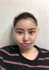 Facial Contour + Revision Nose Surgery — Korea cost, reviews & before-after | MISOODA
