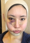 Facial Contour, Chin Reduction, Nose&Eye Surgery After 2 years — Korea cost, reviews & before-after | MISOODA