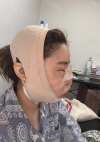 Facial Contour + Revision Nose Surgery — Korea cost, reviews & before-after | MISOODA