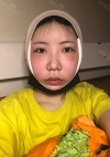 Facial Contour, Double Eyelid Surgery in TS PS!! — Korea cost, reviews & before-after | MISOODA