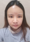Nose, Eye, Fat Graft After 1 year!!! — Korea cost, reviews & before-after | MISOODA
