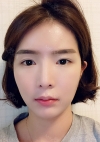 Double eyelids revision & Nose revision :) — Korea cost, reviews & before-after | MISOODA