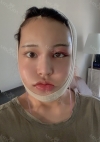 Facial Contour, Chin Reduction, Fat Graft ~!! — Korea cost, reviews & before-after | MISOODA