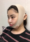 Facial Contour + Revision Nose Surgery — Korea cost, reviews & before-after | MISOODA