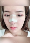 Double eyelids revision & Nose revision :) — Korea cost, reviews & before-after | MISOODA