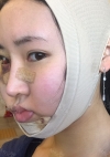Facial Contour, Chin Reduction, Nose&Eye Surgery After 2 years — Korea cost, reviews & before-after | MISOODA