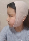 Nose, Eye, Fat Graft After 1 year!!! — Korea cost, reviews & before-after | MISOODA