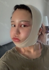 Facial Contour, Chin Reduction, Fat Graft ~!! — Korea cost, reviews & before-after | MISOODA