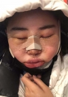 Facial Contour + Revision Nose Surgery — Korea cost, reviews & before-after | MISOODA