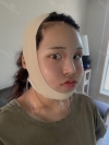 Facial Contour, Chin Reduction, Fat Graft ~!! — Korea cost, reviews & before-after | MISOODA